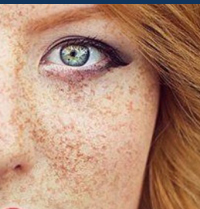 Skin Pigmentation