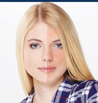 Rosacea