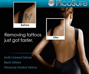 Tattoo Removal with PicoSure