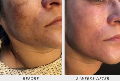 melasma treatment ireland