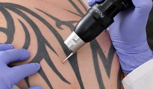 tattoo removal dundrum