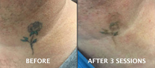 Everything youve ever wanted to know about laser tattoo removal  Dazed