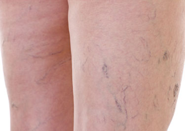 Thread Veins Removal