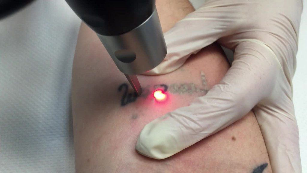 Laser-Tattoo-Removal-Dublin