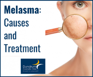 Melasma