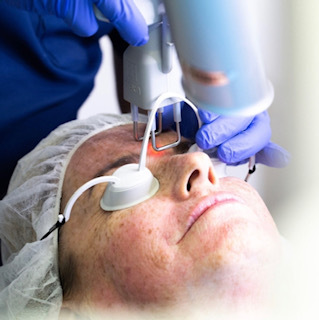 laser skin resurfacing