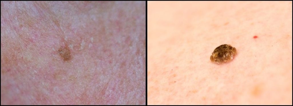 seborrheic keratosis