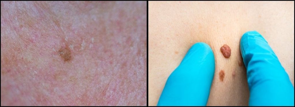 seborrheic keratosis vs skin tags