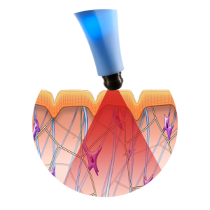 btl exilis ultra 360 how it works vaginal rejuvenation