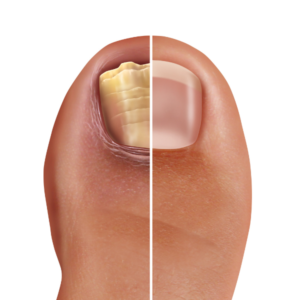 fungal nail treatment dublin